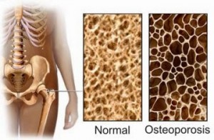 osteoporosis_exercise_prevention